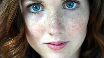 البقع البنية في الوجه