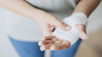 مدة شفاء الحروق