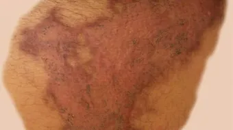 آثار الحروق