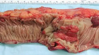 شكل ورم السرطان