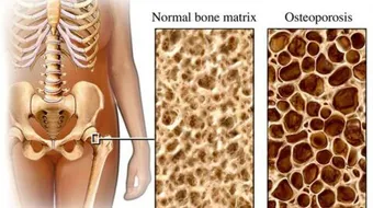 أسباب هشاشة العظام وعلاجها