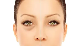 أسباب حول العين