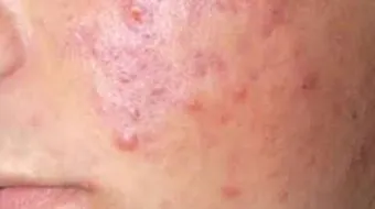 أسباب ظهور حب الشباب