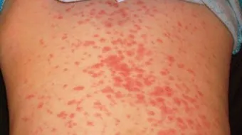 أسباب الحساسية