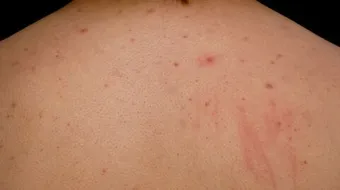 أسباب حبوب الظهر