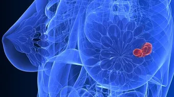 أسباب سرطان الثدي