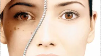 أسباب البقع البنية في الوجه