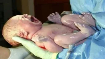 أسباب الولادة القيصرية