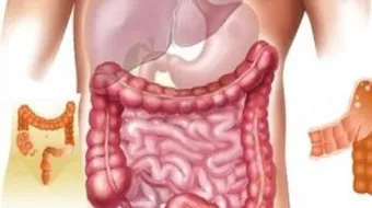 أسباب سرطان القولون