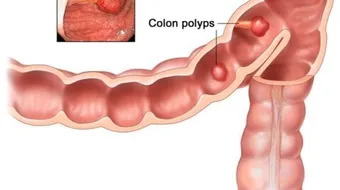 أسباب مرض القولون
