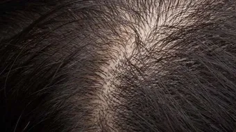 أسباب قشرة الشعر