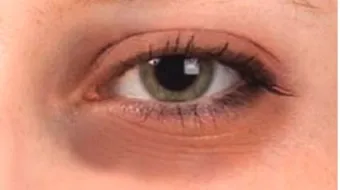 أسباب الهالات السوداء