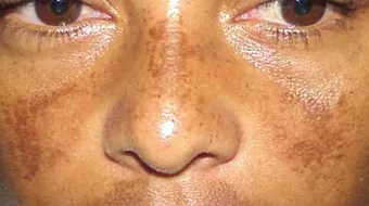 أسباب سواد الوجه