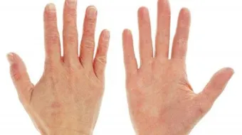 أسباب جفاف اليدين