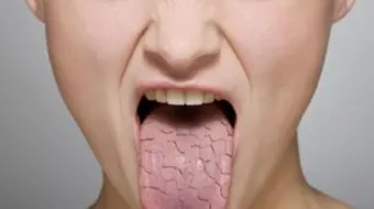 أسباب جفاف الحلق واللسان