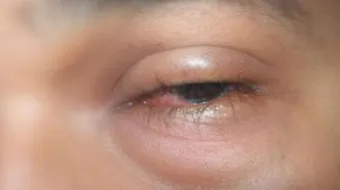 أسباب انتفاخ العين