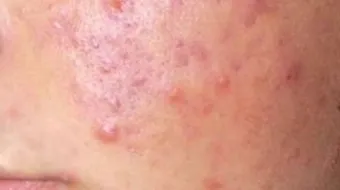 أسباب حساسية الوجه