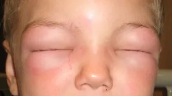 أسباب تورم الوجه