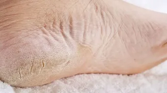 أسباب تشققات القدم