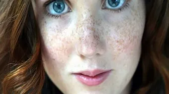 أسباب ظهور النمش