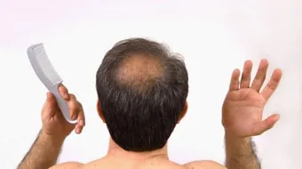 أسباب تساقط الشعر عند الرجال