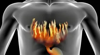 أسباب حرقة المعدة