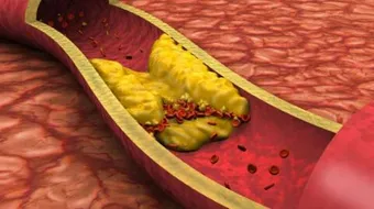 أسباب زيادة الكولسترول