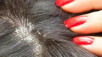 أسباب القمل وعلاجه