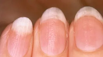أسباب تغير لون الأظافر