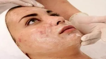 أسباب البثور في الوجه