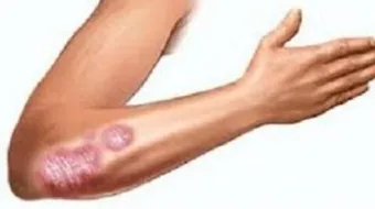 أسباب الصدفية