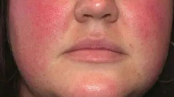 أسباب احمرار الوجه وسخونته