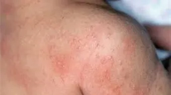 أسباب الطفح الجلدي المفاجئ عند الكبار