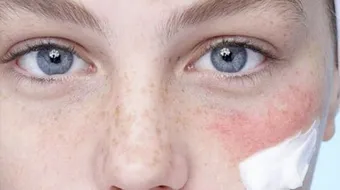 أسباب احمرار الوجه المفاجئ