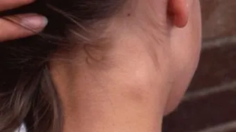 أسباب ظهور الغدد اللمفاوية في الرقبة