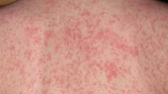 أسباب الطفح الجلدي