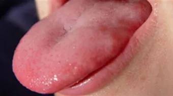 أسباب تقرح اللسان