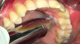 أسباب خراج الأسنان