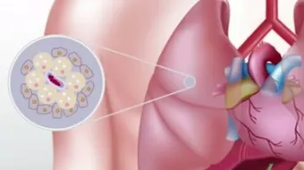 أسباب مرض السل