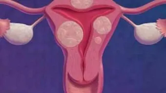 أسباب تليف الرحم