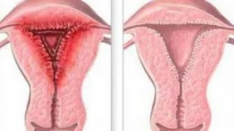 أسباب التهاب الرحم