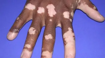 أسباب مرض البهاق