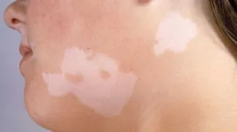 أسباب البهاق وعلاجه