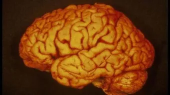 ضمور المخيخ عند الكبار