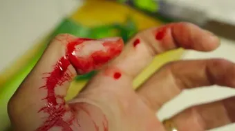 آثار تجلط الدم