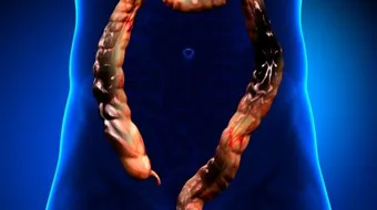 أورام القولون