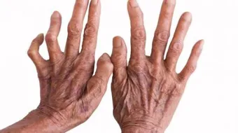 مضاعفات مرض الجذام