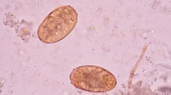 مضاعفات البلهارسيا