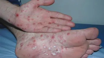 مضاعفات المرحلة الثانية من مرض الزهري