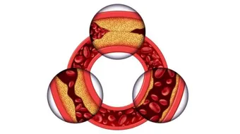 أمراض شرايين القلب التاجية